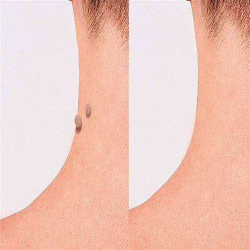 FORMUCLEAR SKINTAG - belteleachat