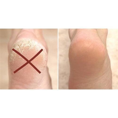 PEDIBLISS X2 - belteleachat